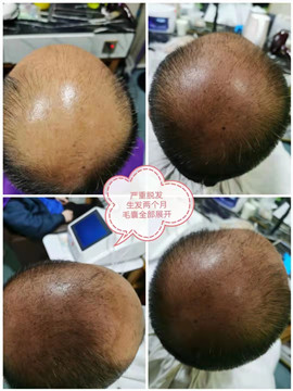 秀丝顿植物养发头部理疗首先用中草药清洗头皮，疏通毛囊