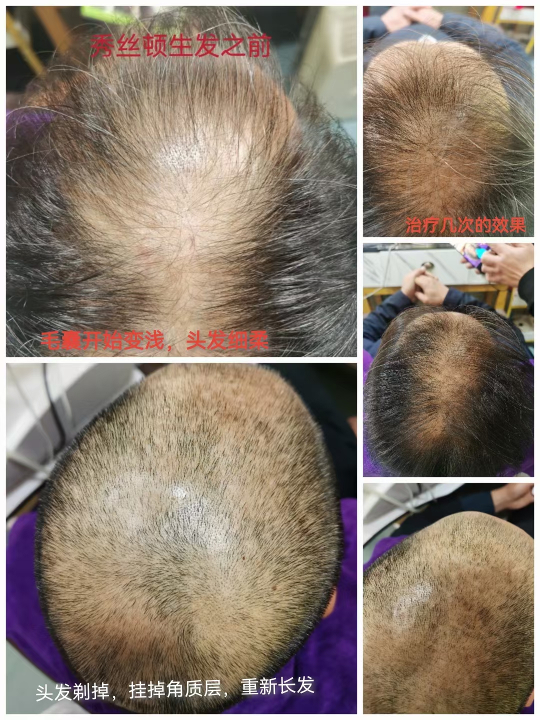 秀丝顿植物养发不但是修复受损的发干，同时是把毛囊头皮等从里到外的根本上修复。