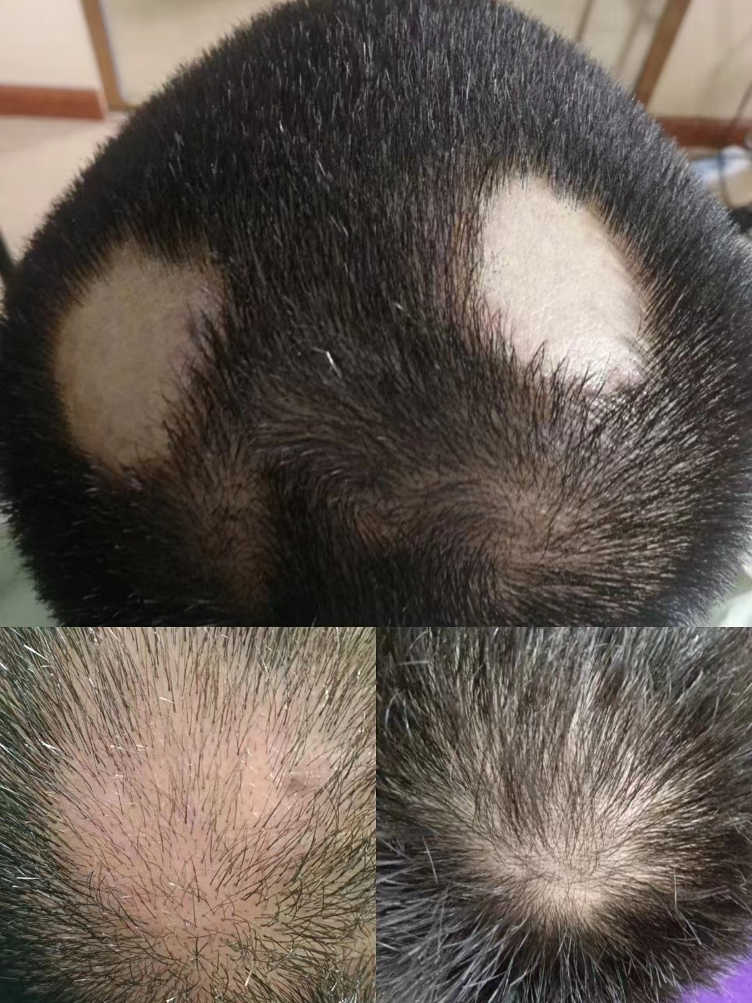 秀丝顿头部理疗促进血液循环，改善头皮毛囊新陈代谢，激活毛囊利于生发延缓白发生成