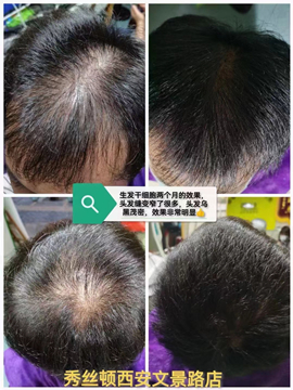 秀丝顿植物养发采用天然植物提取物，针对各种头发问题进行治疗，包括防脱生发、白发转黑、斑秃等