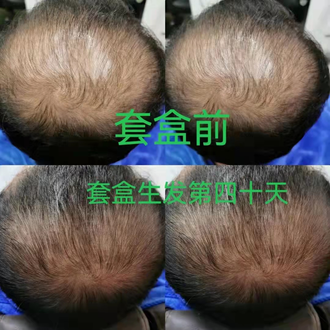 秀丝顿养发头疗在中国植物养发头疗行业里面首屈一指。