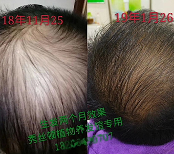 秀丝顿植物养发是一种安全、高效、无刺激的养发产品