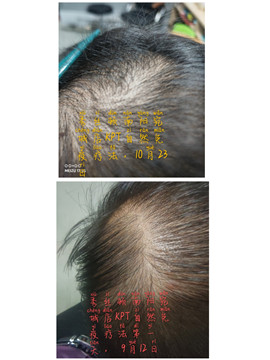 秀丝顿植物养发馆头疗采用传统手法进行学位按摩，梳疗，刮痧等改善睡眠质量，预防脱发，白发
