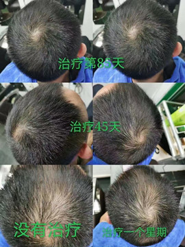 秀丝顿植物养发是一种非常出色的养发产品。它能够有效地解决你的白发